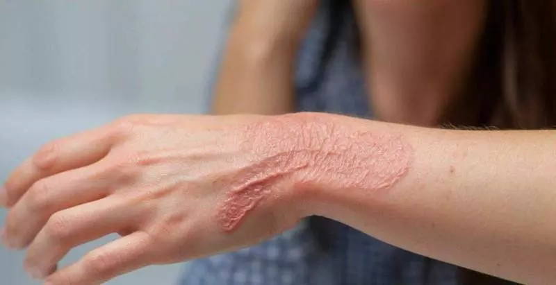 Как восстановить кожный барьер рук после мытья и антисептиков